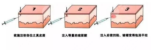 自体脂肪活细胞除皱结果好吗?