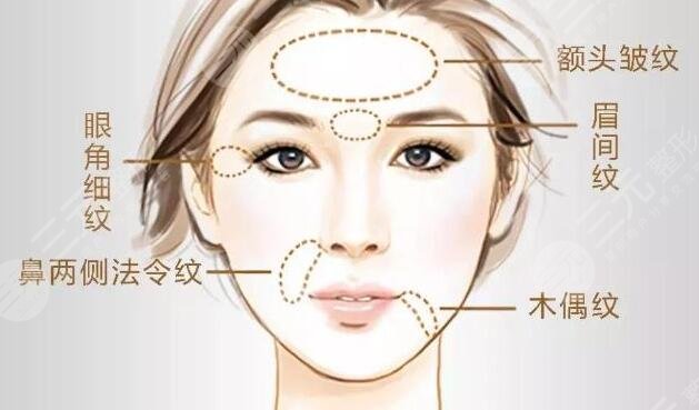 自体脂肪除皱特点