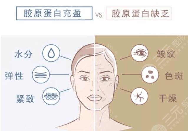 注射胶原蛋白好不好?