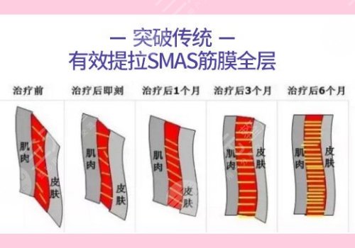 黄金热拉提和超声炮哪个更好？