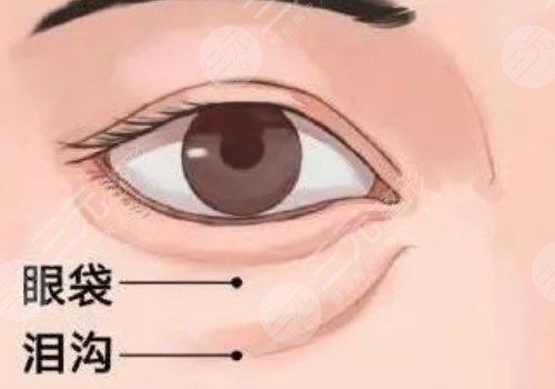 泪沟凹陷怎么解决好？
