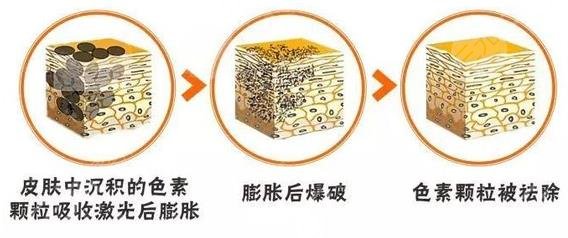 激光祛斑的副作用和危害性