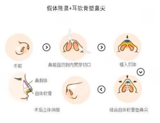 隆鼻