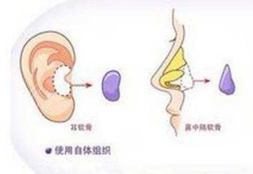 隆鼻