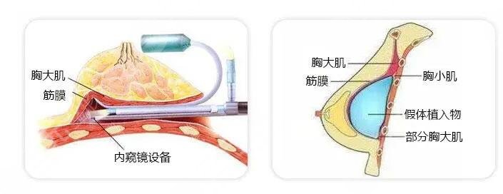 隆胸手术后要注意什么?