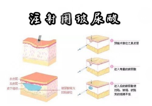 玻尿酸丰胸的作用与危害有哪些？