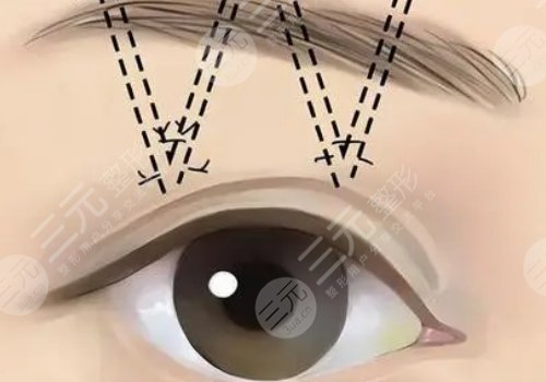 筋膜悬吊提眉和普通提眉哪个好?