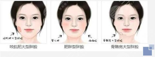 手术瘦脸后注意事项