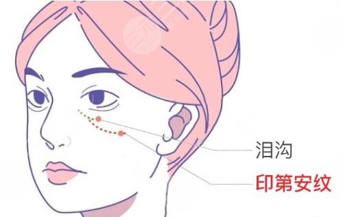 宝尼达填充泪沟可以吗？