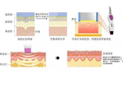 黄金热拉提2.0做一次能维持多久?