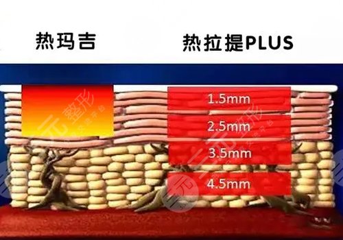黄金热拉提和热玛吉的区别是什么？哪个更贵？