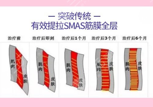 黄金热拉提和热玛吉的区别是什么？哪个更贵？