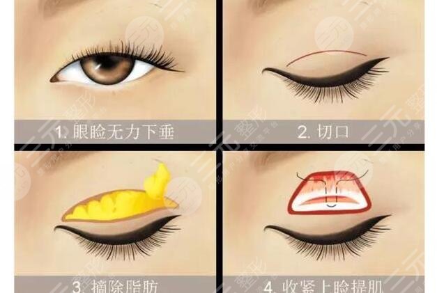 眼周筋膜悬吊能维持多久？