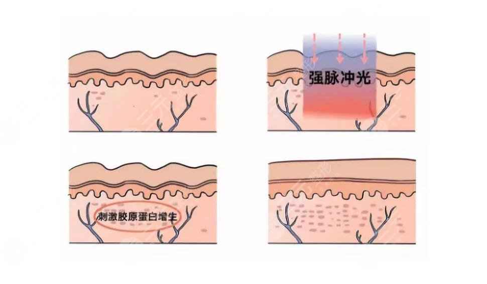 水光补水和光子嫩肤一样吗？