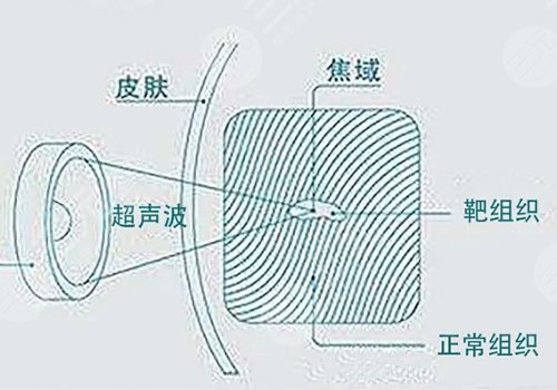眼周细纹做什么医美可以去除？