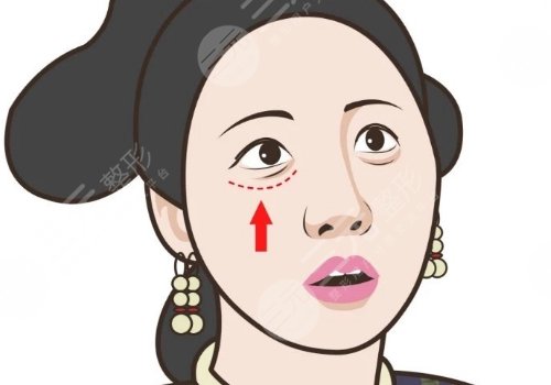泪沟怎样去除可靠？
