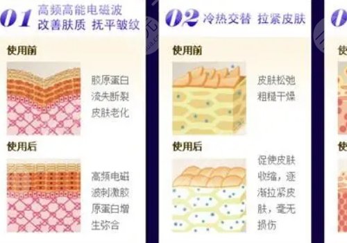 热玛吉的原理和功效是什么？