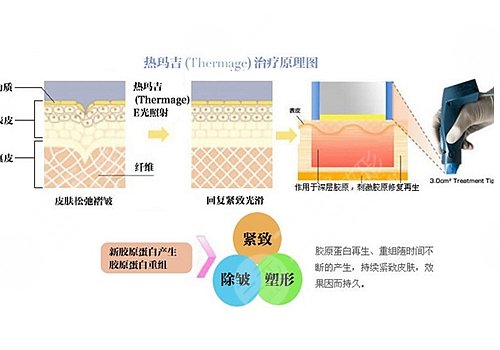 热玛吉的原理和功效是什么？