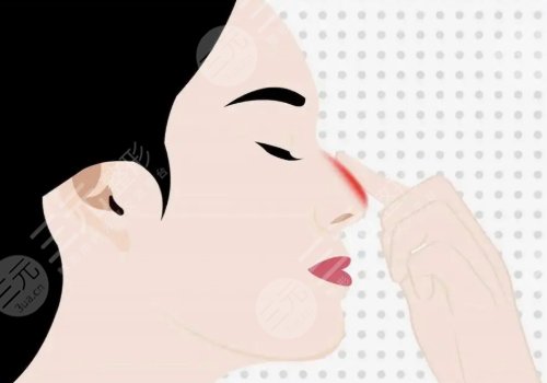 宝尼达隆鼻可以维持多久？