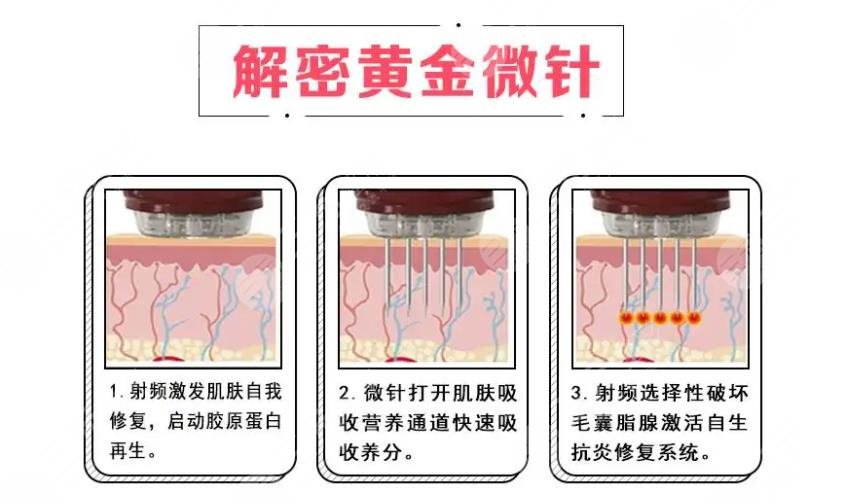 黄金热拉提2.0做一次能维持多久