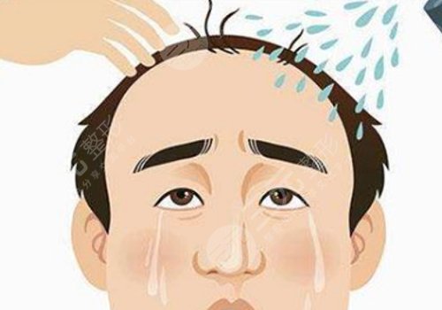 纹发和植发哪个效果好？