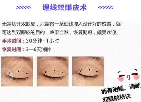 埋线双眼皮
