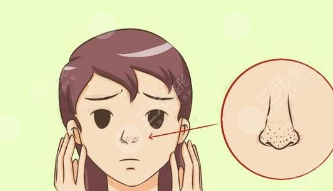 鼻子上毛孔粗怎么办