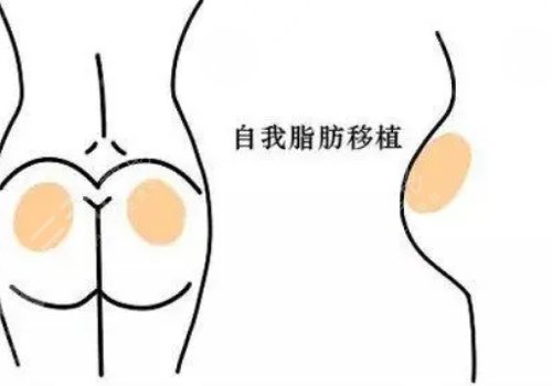脂肪填充臀部可以维持多久？