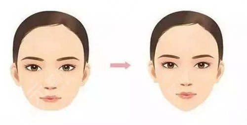 垫下巴硅胶和膨体哪个好?