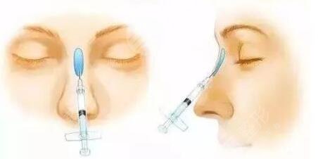 注射隆鼻的材料