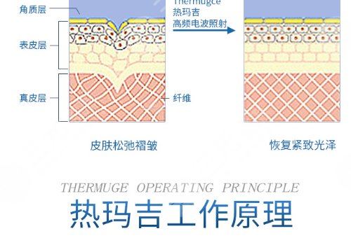 热玛吉能维持多长时间？