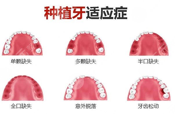 种植牙需要几个过程才能完成?
