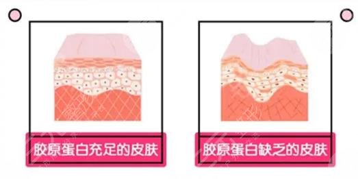 胶原蛋白除皱