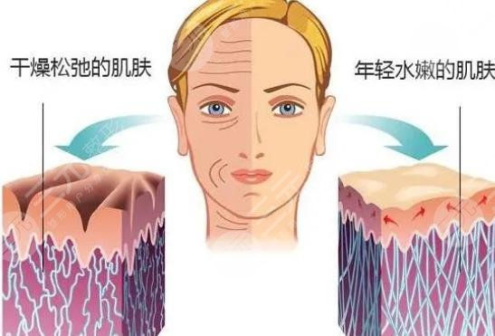 胶原蛋白除皱