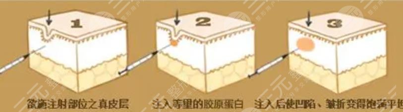 胶原蛋白除皱