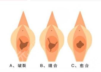 处女磨修复