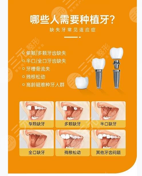 牙种植体什么牌子的好一点?