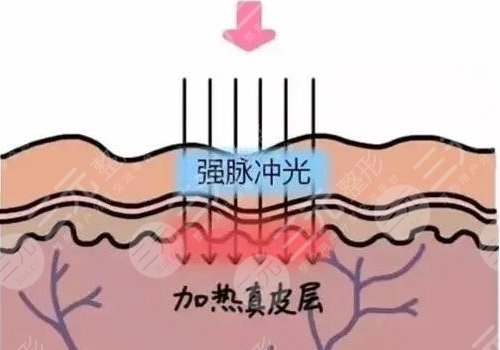 热玛吉和超声炮哪个效果好？