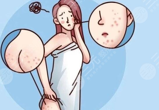 结节性痒疹