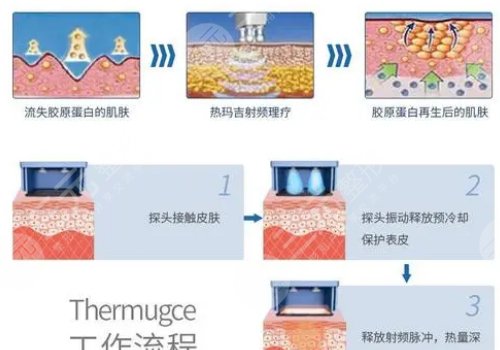 热玛吉一个疗程价格是多少？