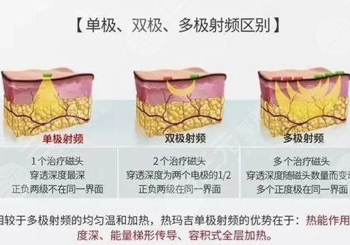 热玛吉全脸做一次多少钱?