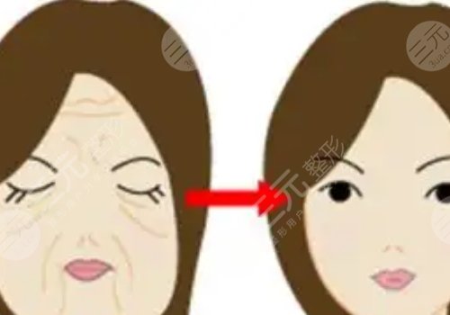 热玛吉全脸做一次多少钱?