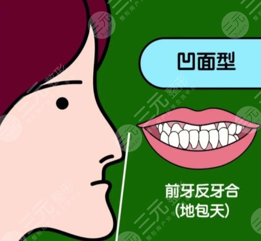 地包天轻微与严重图片分级对比，看看你是第几级？不同级别矫正的方案不同！