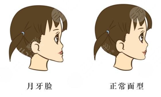 地包天矫正需要多少钱?