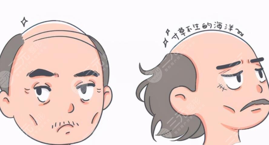 脱发