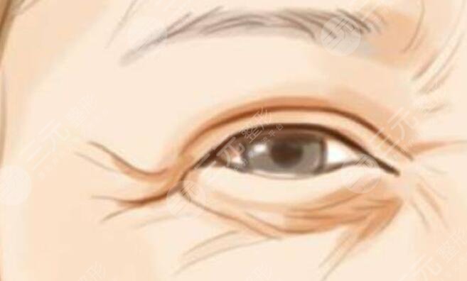 鱼尾纹
