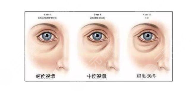玻尿酸注射泪沟可以?保持多久?