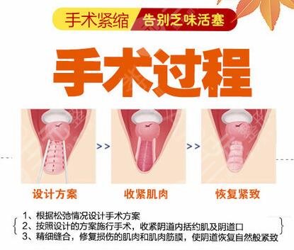 私密整形