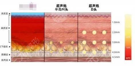 超声炮和热玛吉的区别是什么？