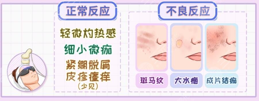 光子嫩肤收缩毛孔效果